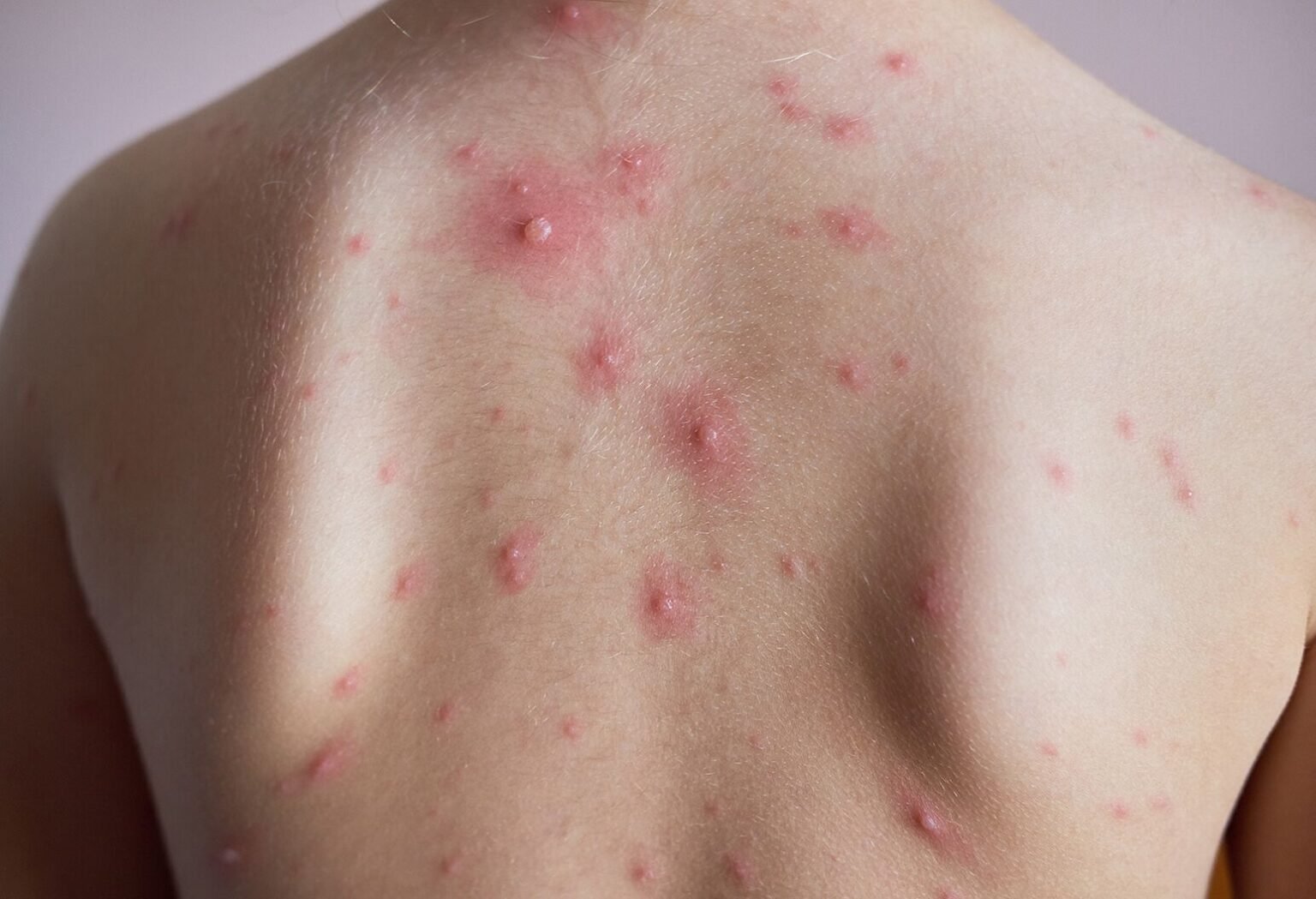 Rashes - Natural Health Group